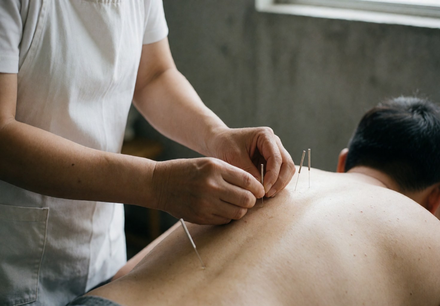 Professional acupuncturist inserting needles into a patient's back during a therapy session, hands and needles visible against a concrete wall with natural light