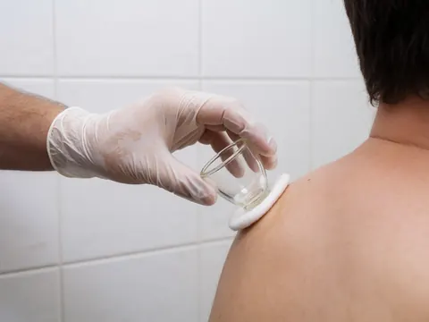 Close-up of a therapist's gloved hand positioning a suction cup on a client's shoulder during a cupping massage session